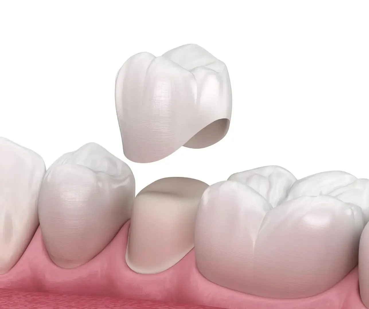 Dental crown being positioned over a prepared tooth among healthy gums and adjacent teeth.