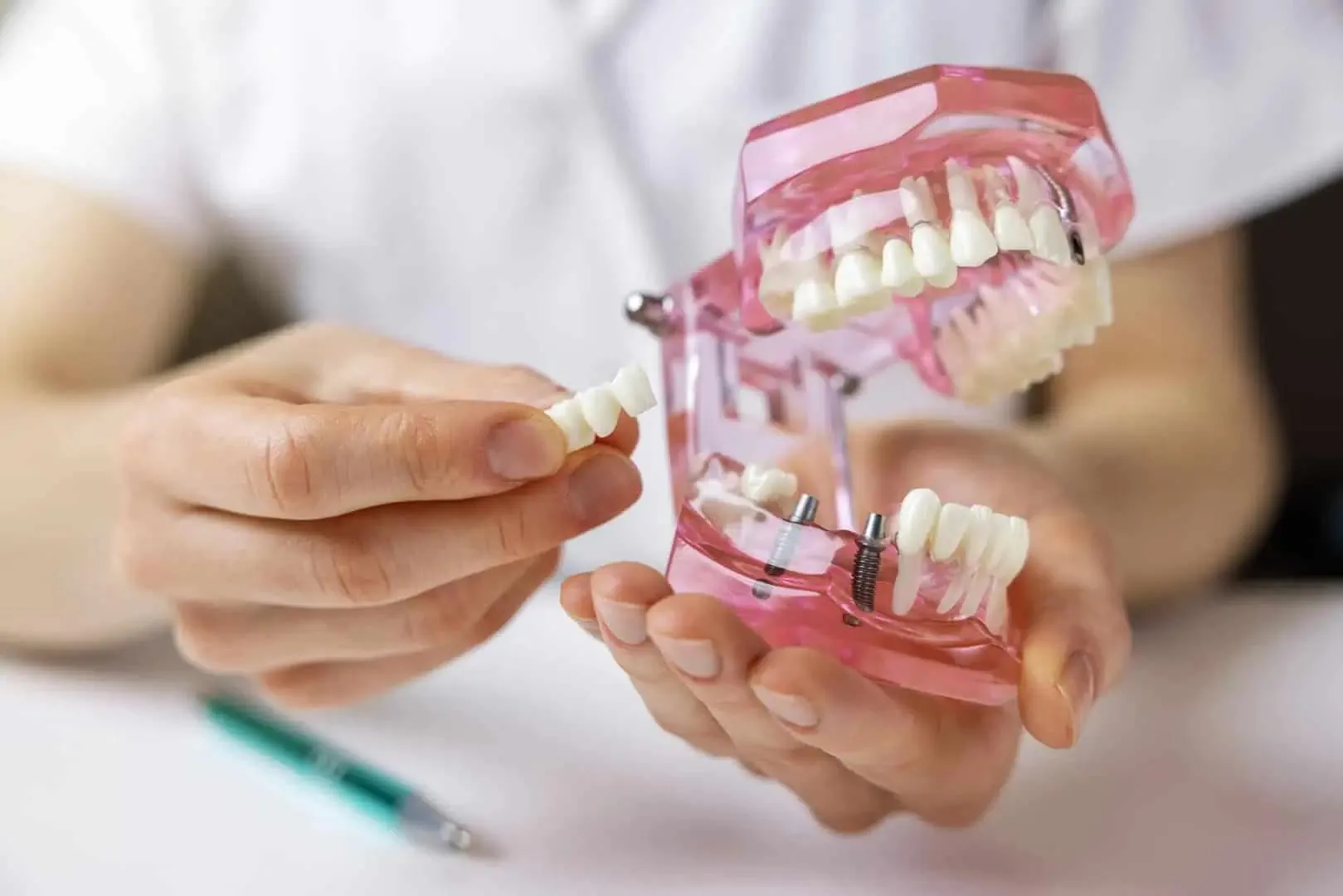 Hands holding dental model with implants showing a removable dental bridge piece.