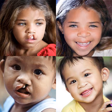Operation Smile Images