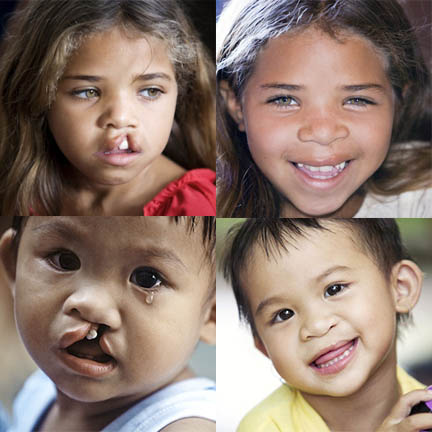 Operation Smile Images