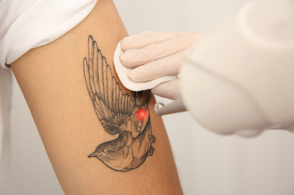 Tattoo Removal  | Vue Medical Spa Salt Lake City