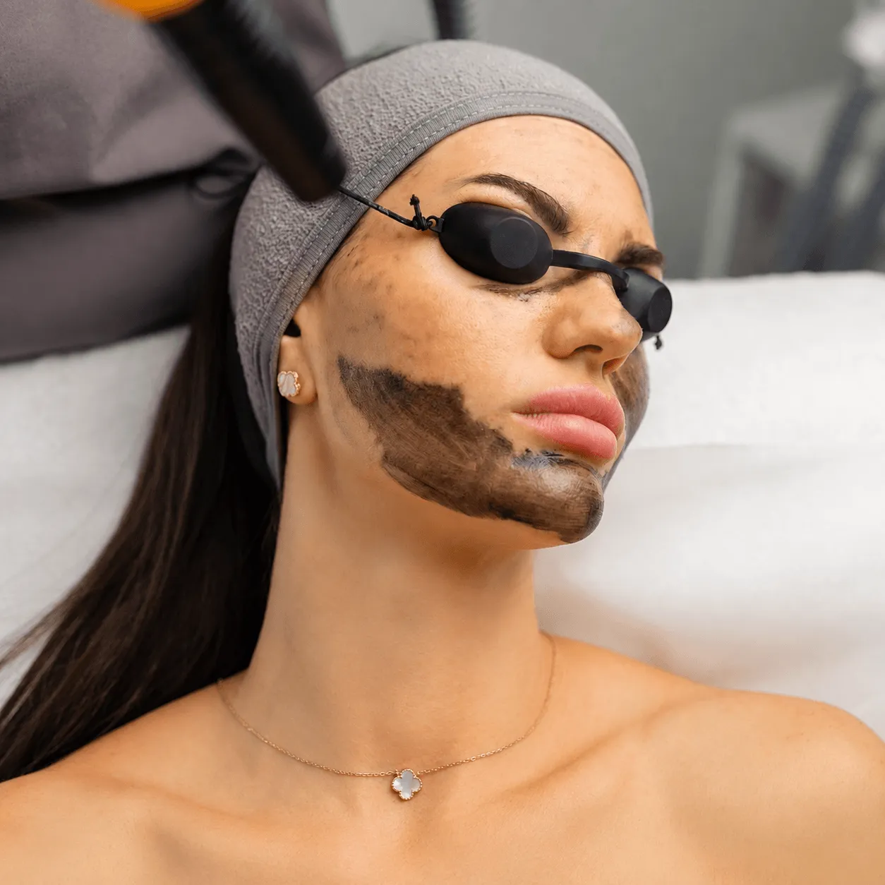 Woman wearing a carbon mask and eye shields during a carbon laser facial