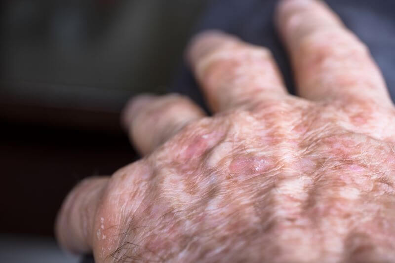 Actinic Keratosis (Pre-cancers)