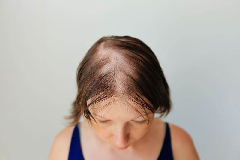 Alopecia (Hair Loss)