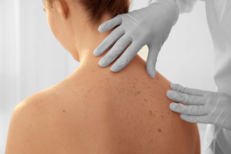 Annual Skin Cancer Exam