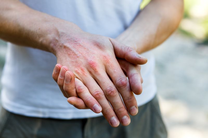 Atopic Dermatitis (Eczema)