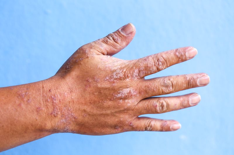 Dermatitis and Rashes