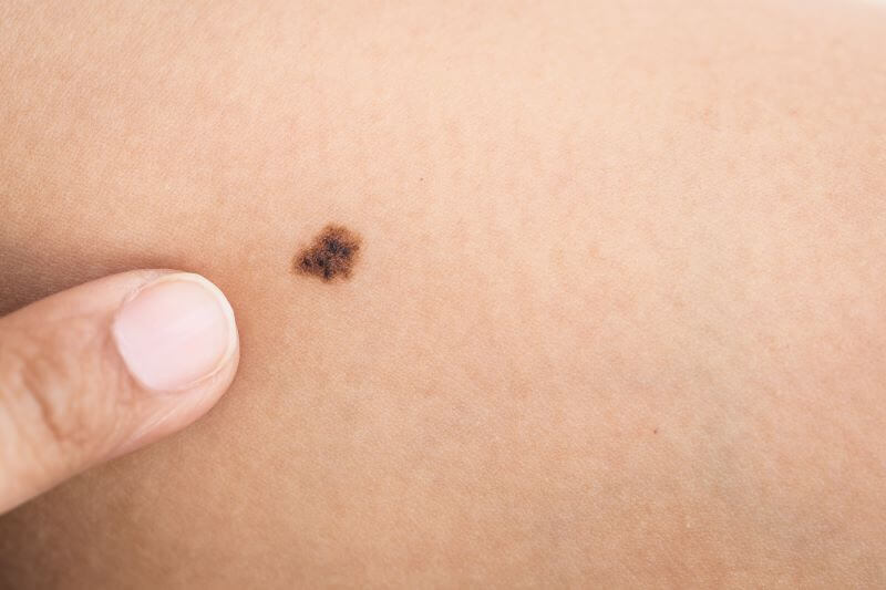 Melanoma