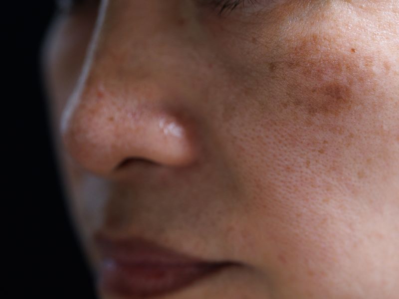 Hyperpigmentation