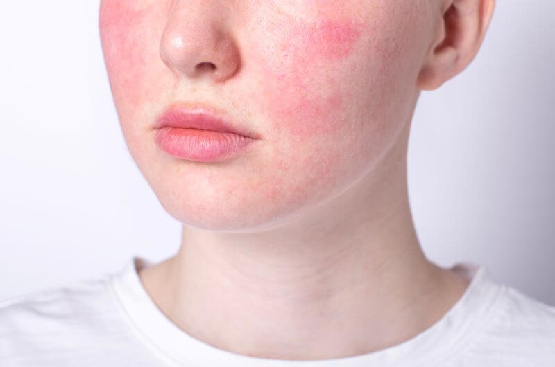 Rosacea