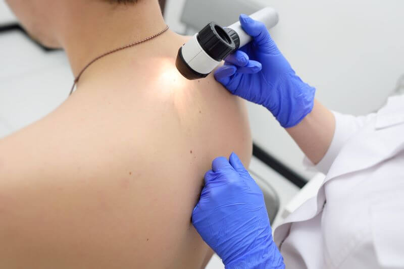 Skin Cancer