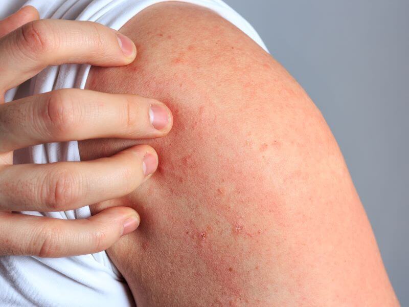 Urticaria (Hives)