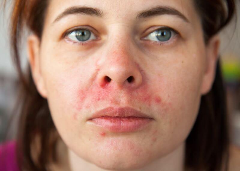Perioral Dermatitis