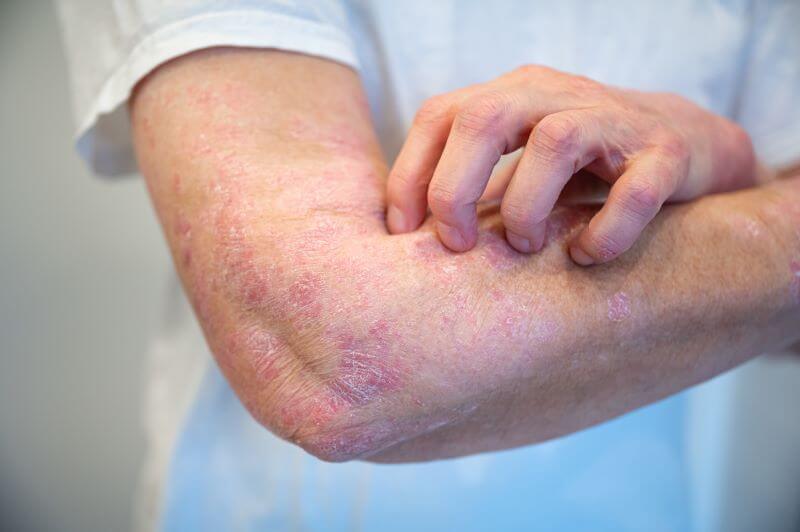 Psoriasis