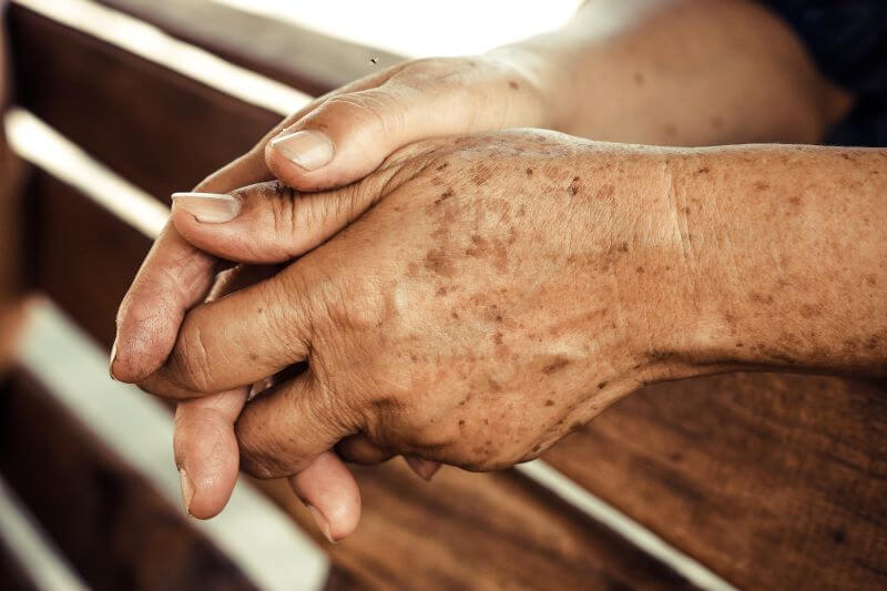 Seborrheic Keratosis (Age spots)