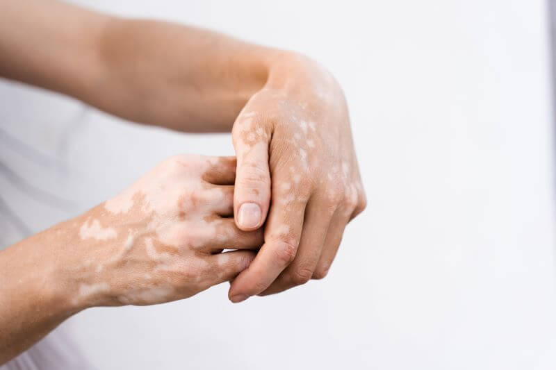 Vitiligo