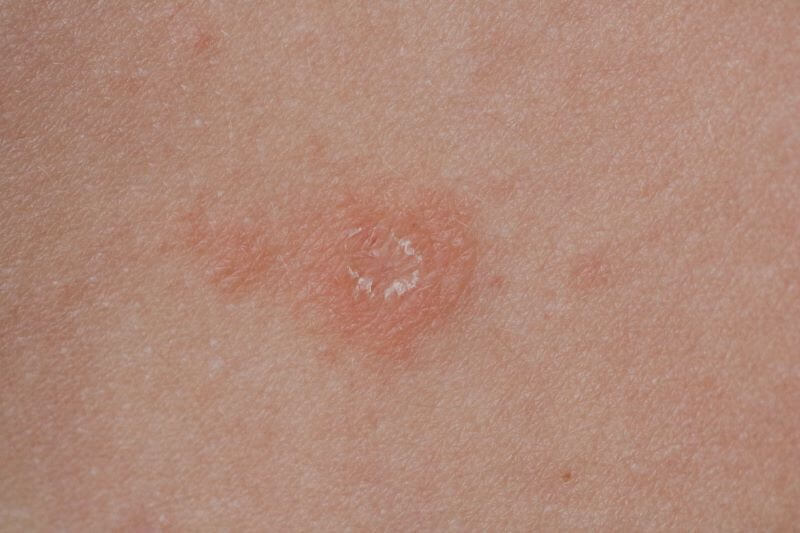 Pityriasis Rosea