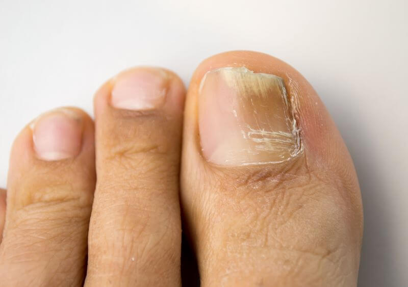 Fungal Infections