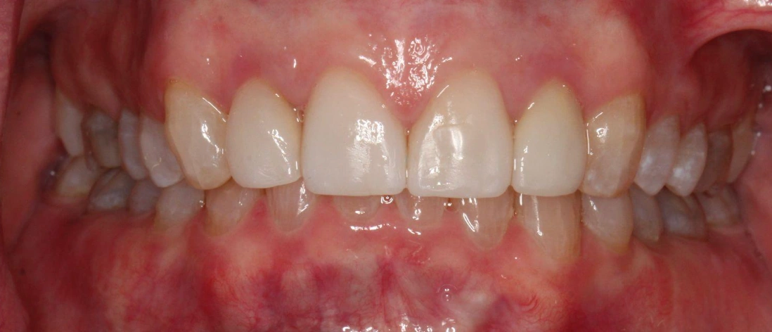 After Image