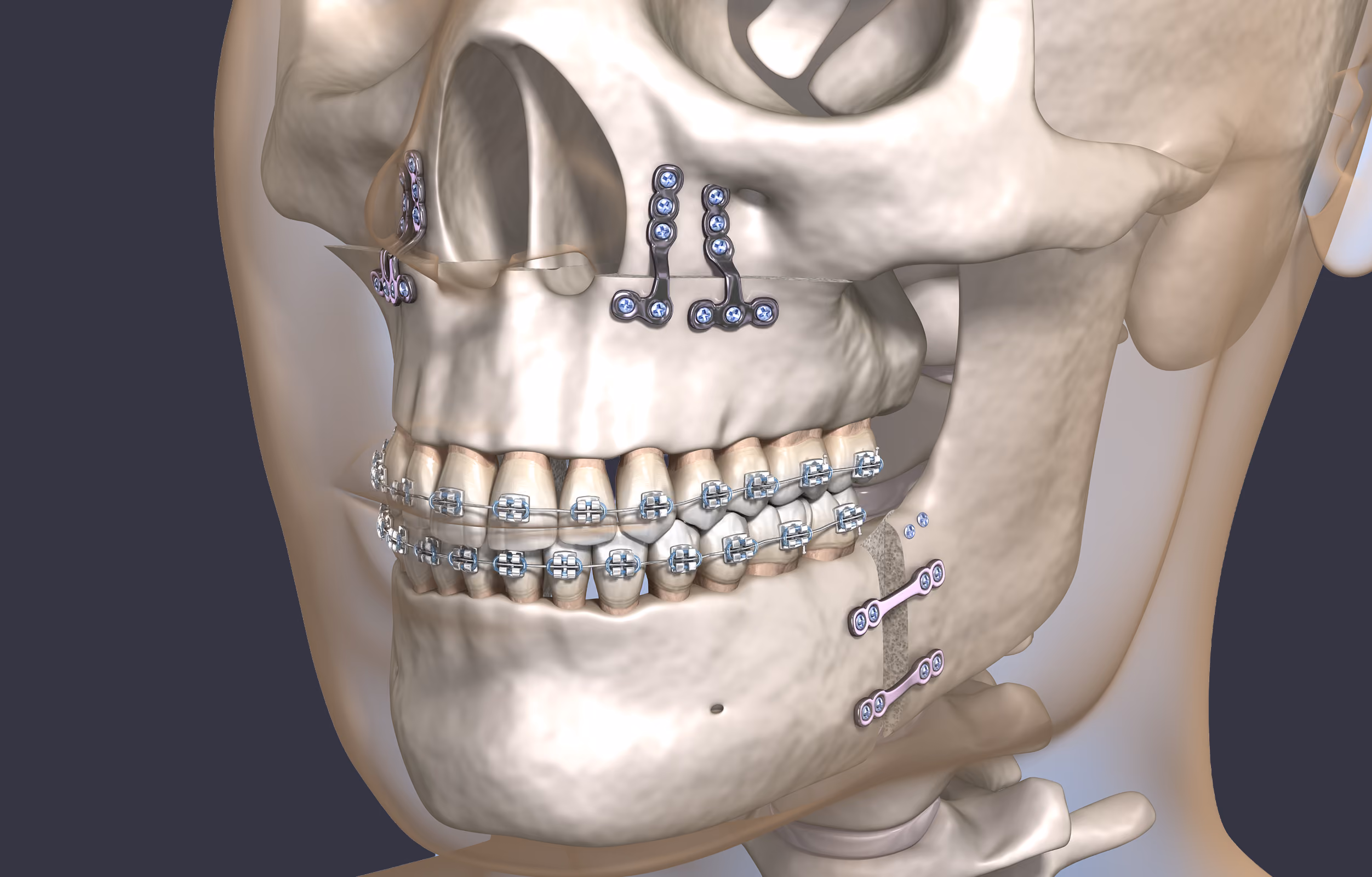 3D skull side view showing jaw surgery with metal plates, screws, and dental braces on teeth.