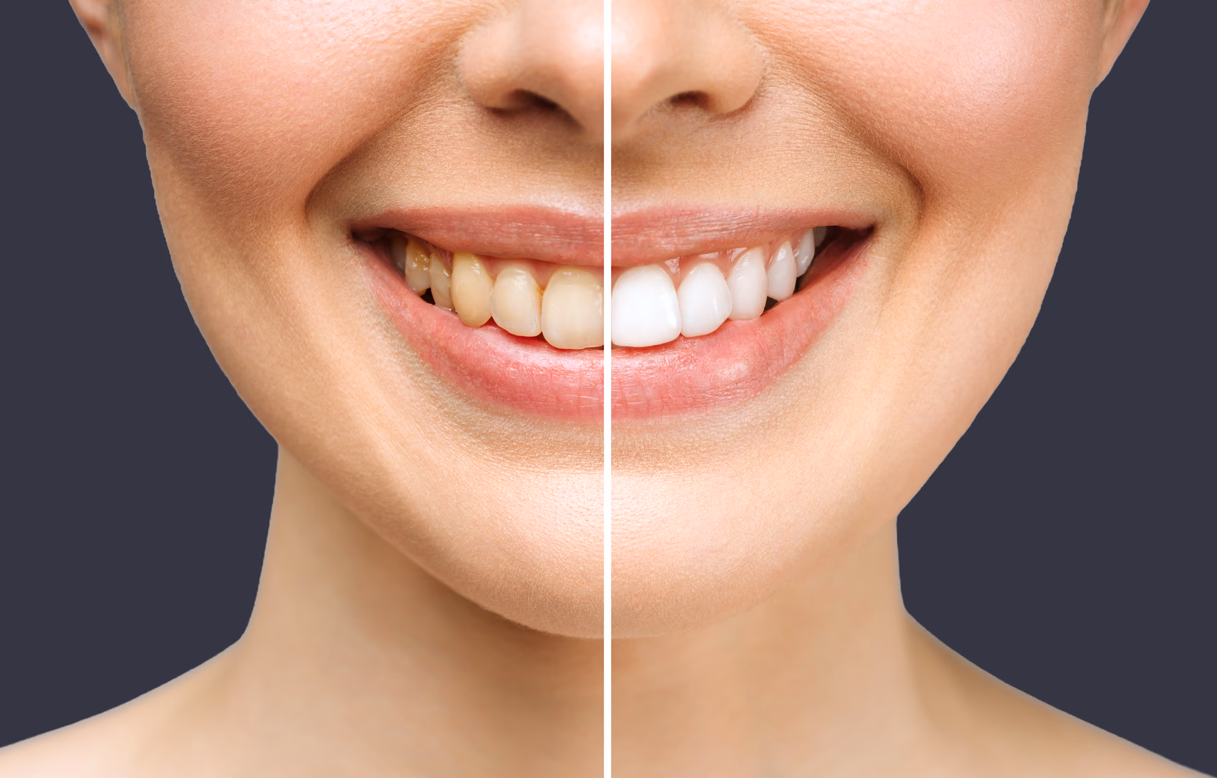 Close-up of a smiling mouth showing teeth before and after whitening treatment split by a white line.