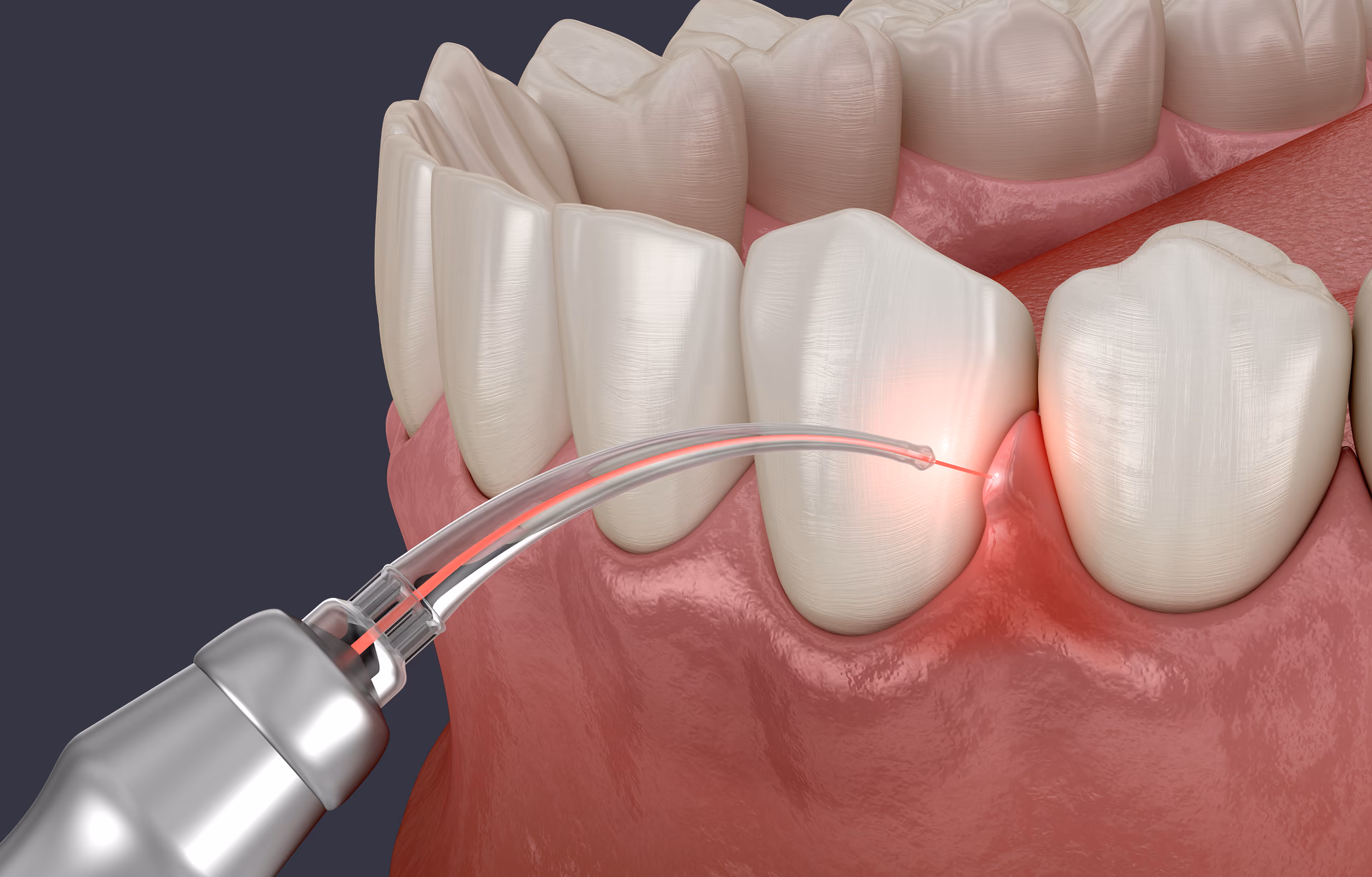 Illustration of a dental laser gingival contouring procedure reshaping the gumline around a front tooth.