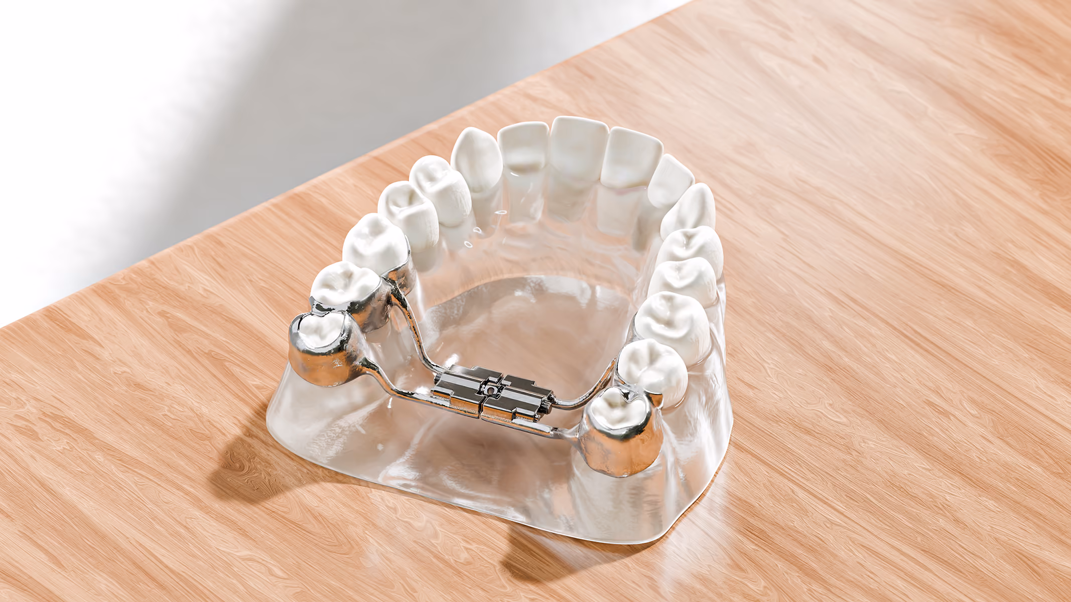 Clear palatal expander with miniscrew anchors and center turning screw, fitted to an upper dental arch model.