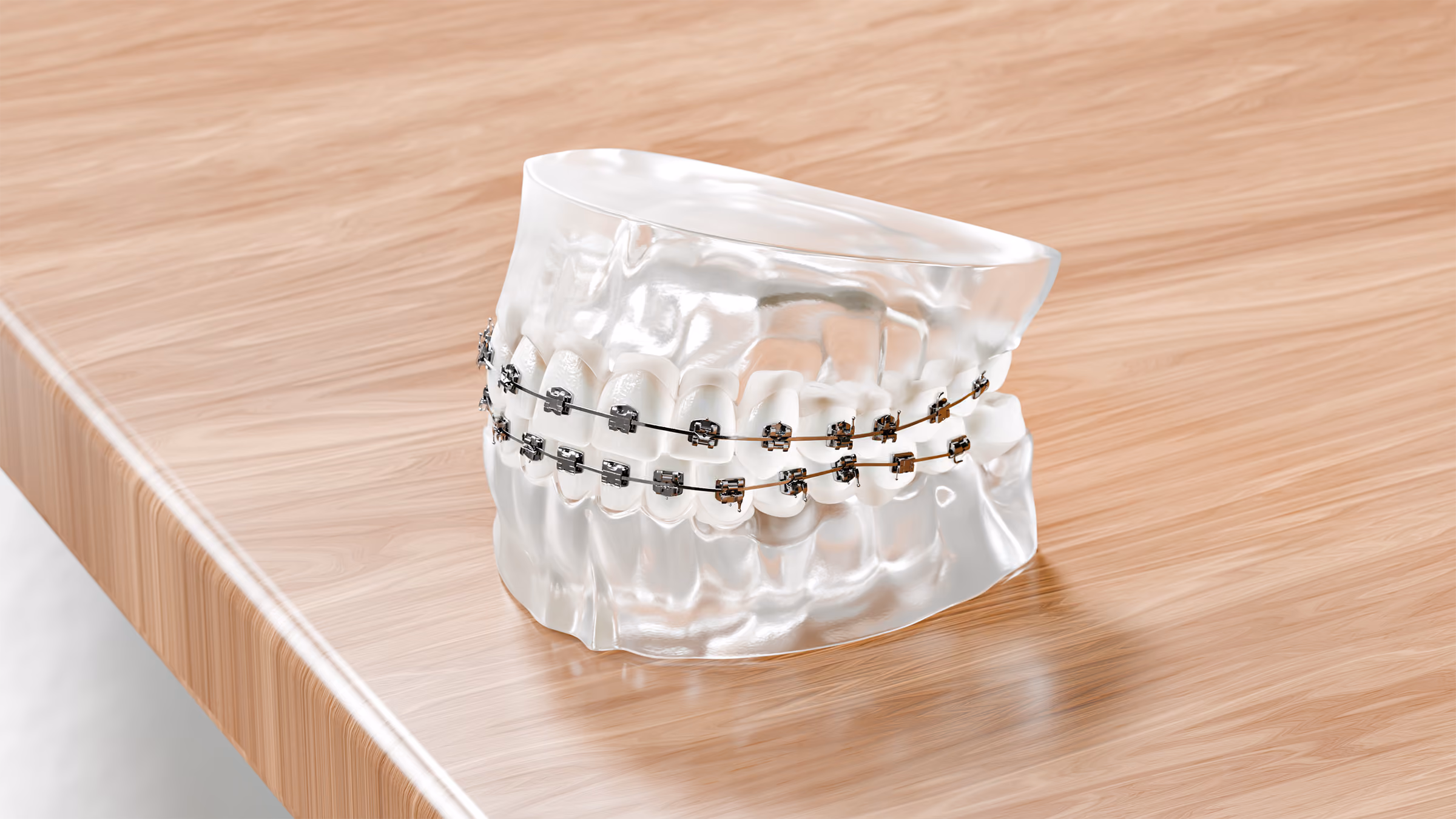 Dental model showing lower teeth fitted with traditional metal braces and archwire.
