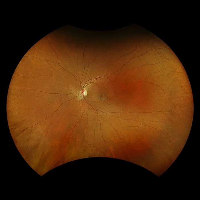 Retina image showing optic disc and network of blood vessels in orange and red tones.