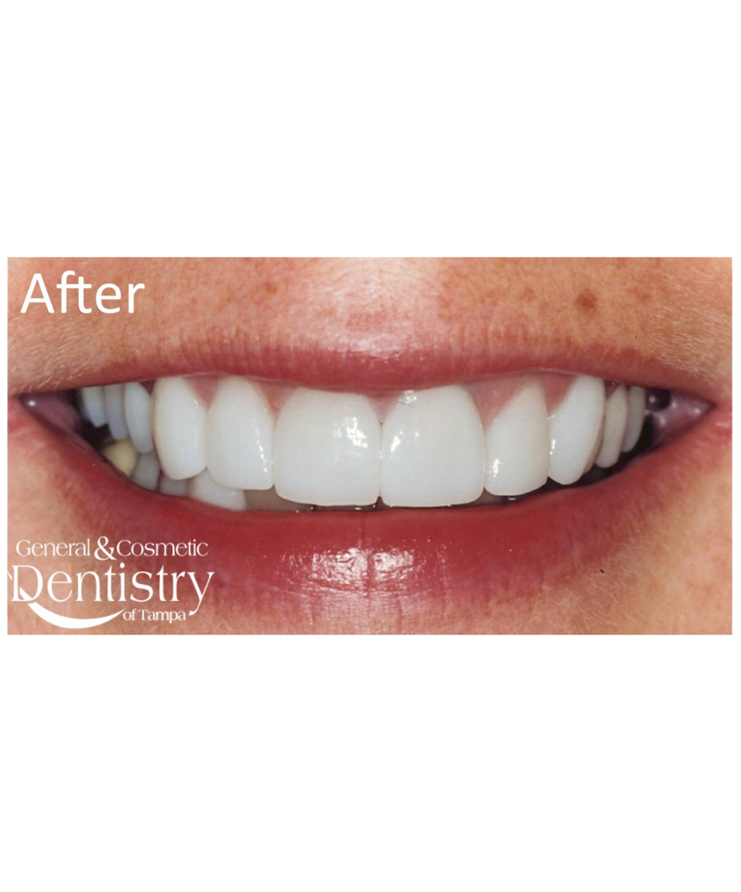 Smile makeover after