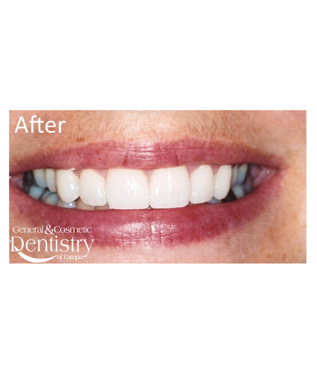 Veneer result from the official practice gallery
