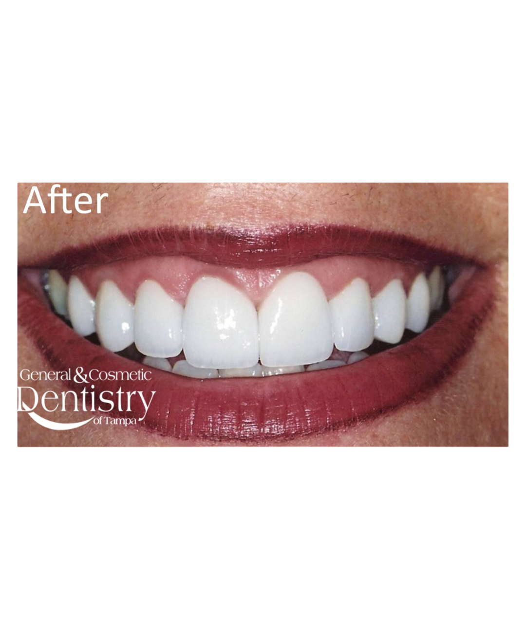 Veneer result from the official practice gallery