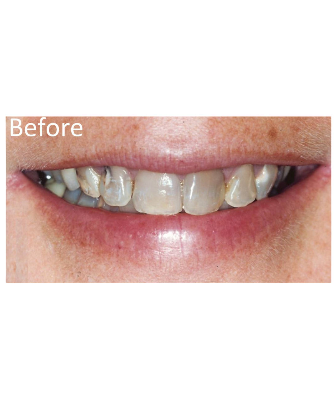 Smile makeover before