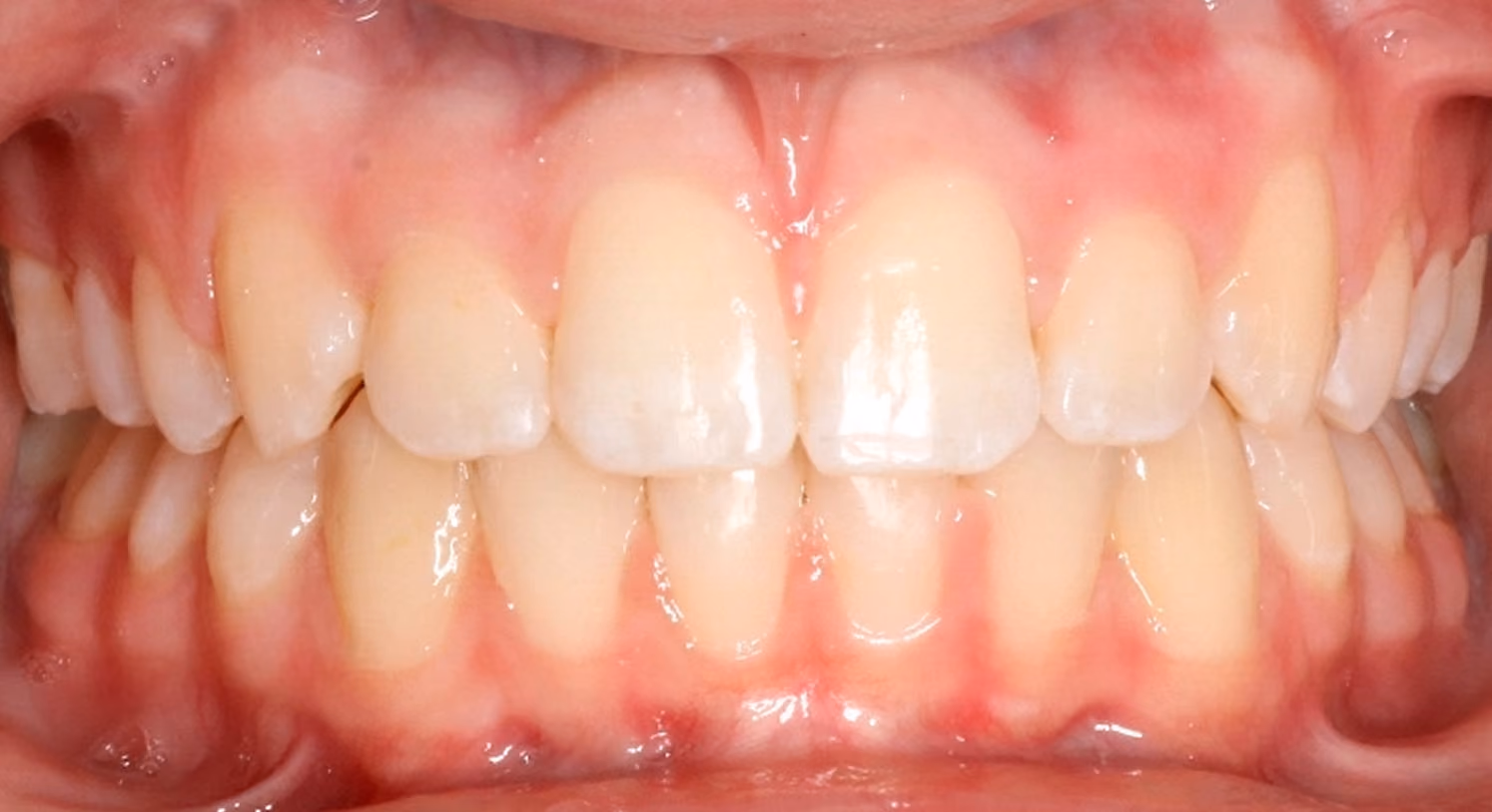 Closeup of teeth after treatment at Lindner Dental Associates