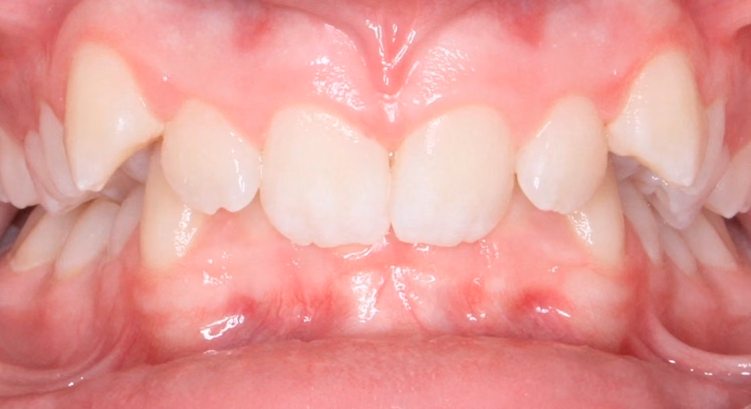Closeup of teeth before treatment at Lindner Dental Associates