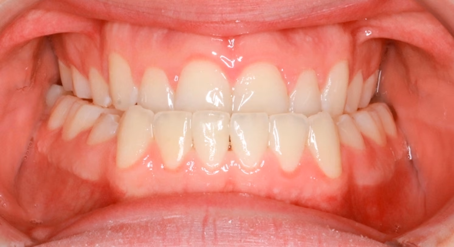 Closeup of teeth before treatment at Lindner Dental Associates