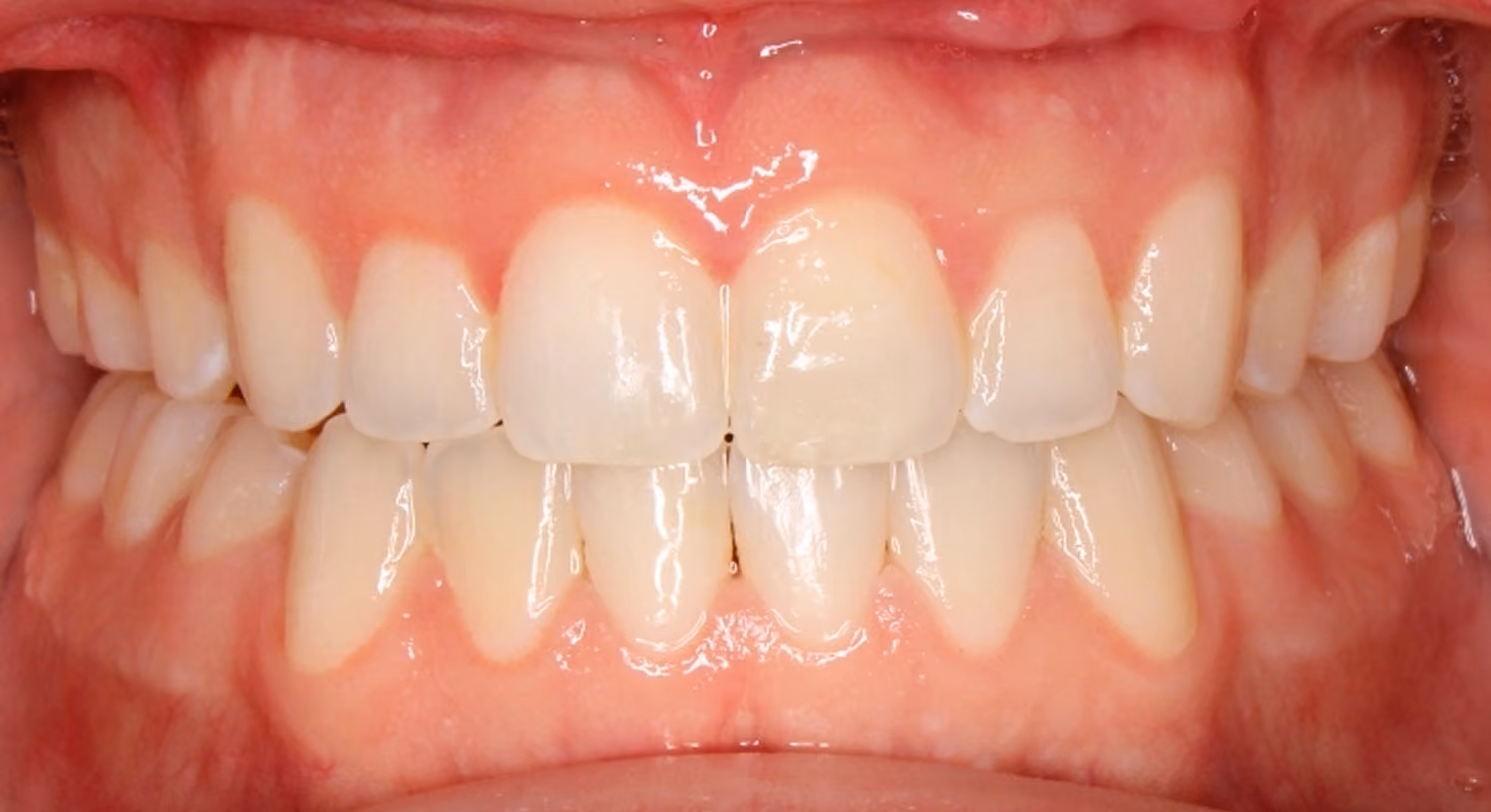 Closeup of teeth after treatment at Lindner Dental Associates