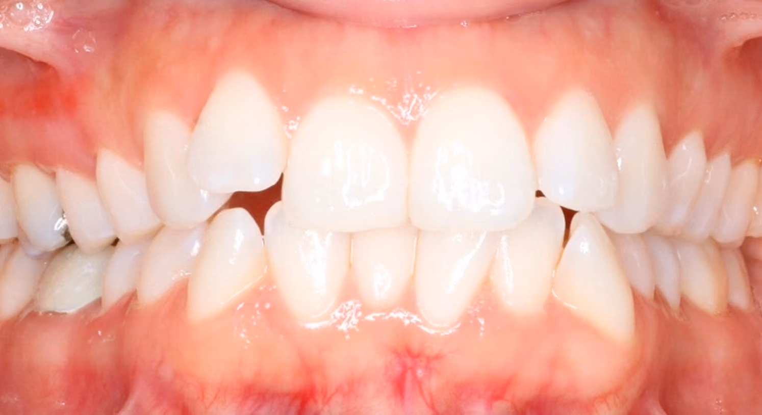 Closeup of teeth before treatment at Lindner Dental Associates