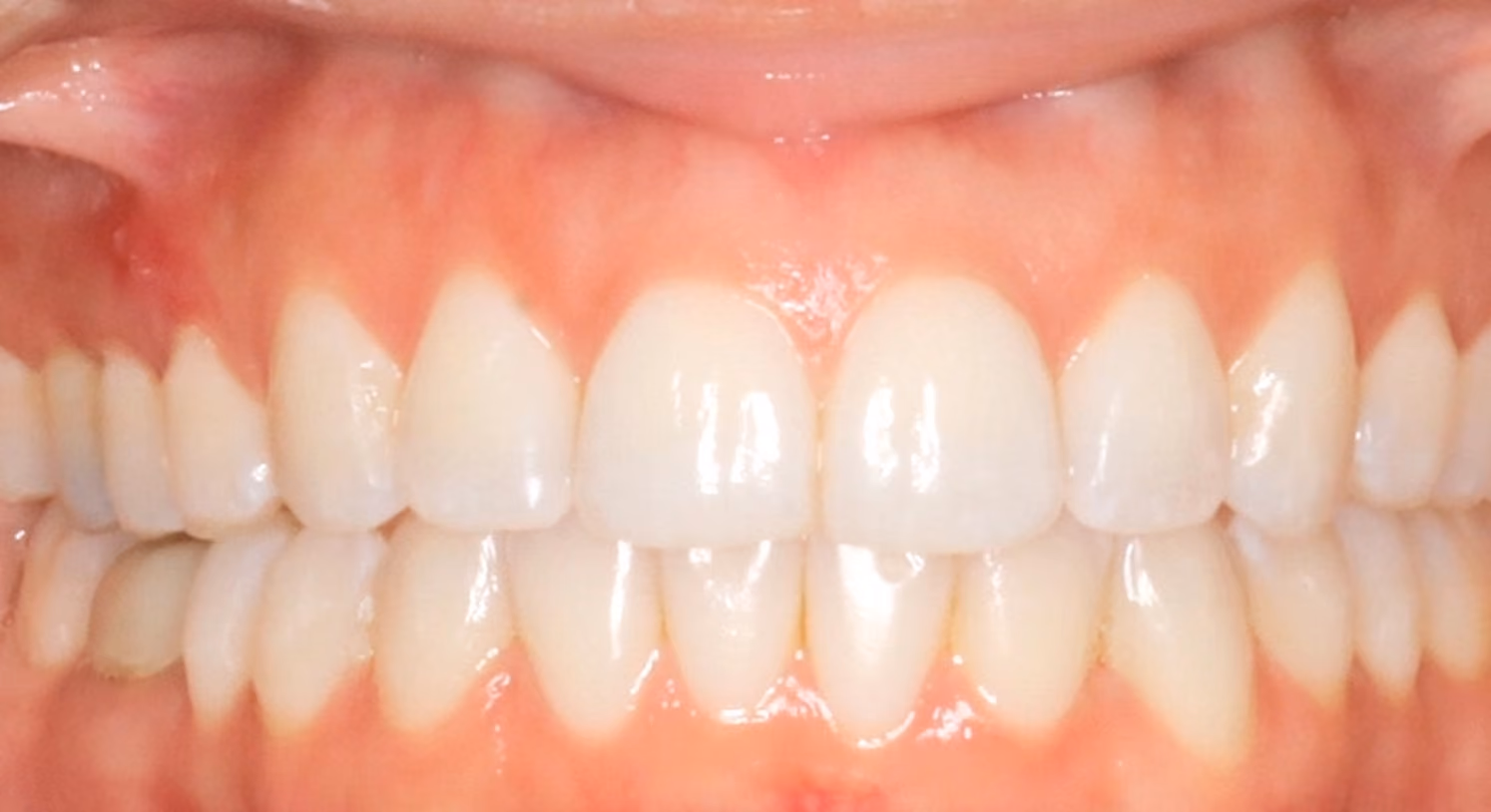 Closeup of teeth after treatment at Lindner Dental Associates