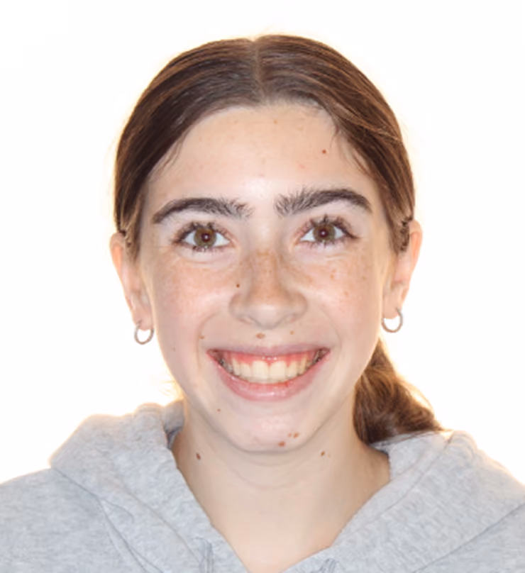 Patient after treatment at Lindner Dental Associates