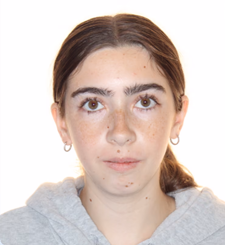 Patient after treatment at Lindner Dental Associates