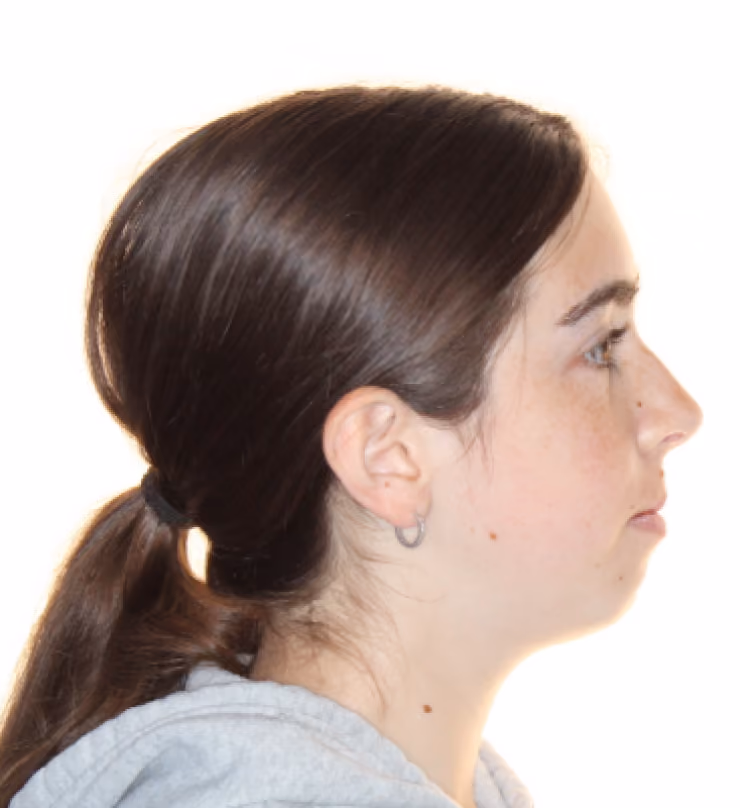 Patient after treatment at Lindner Dental Associates