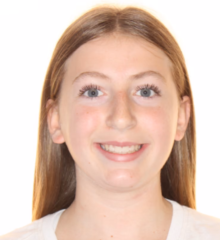 Patient after treatment at Lindner Dental Associates