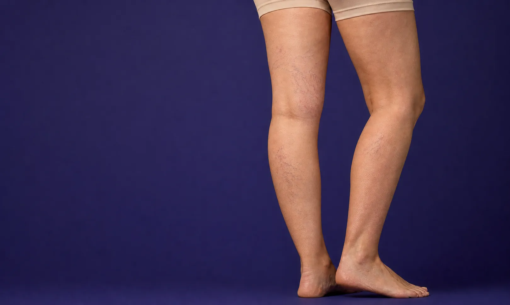 Jambes nues avec varicosités visibles sur la peau, fond bleu uni.