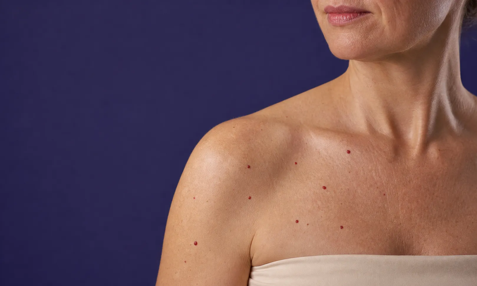 Femme avec taches rouges sur l’épaule et le haut du torse sur fond violet.