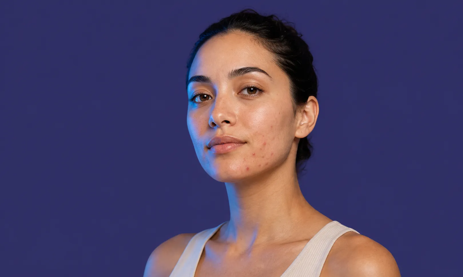 Portrait d'une femme avec de l'acné sur la joue droite sur fond violet.
