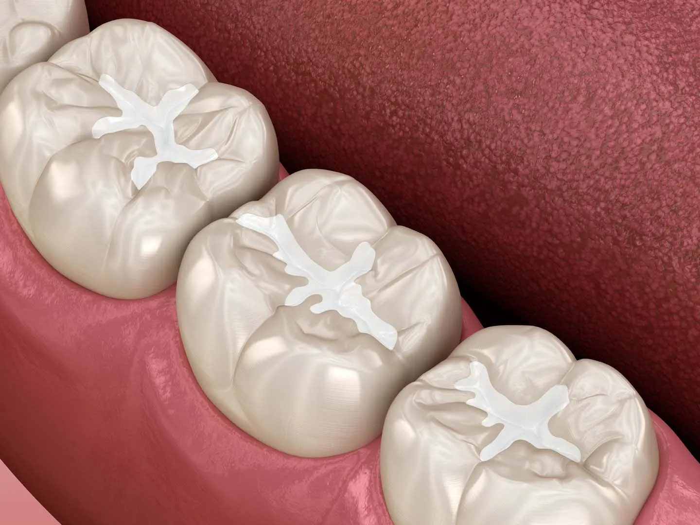 Dental Sealants