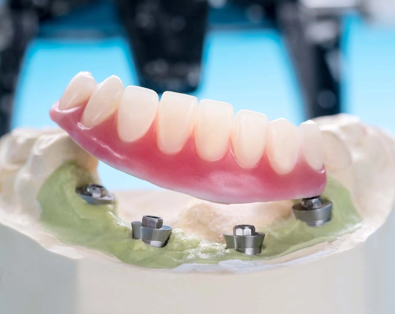 Implant Supported Dentures
