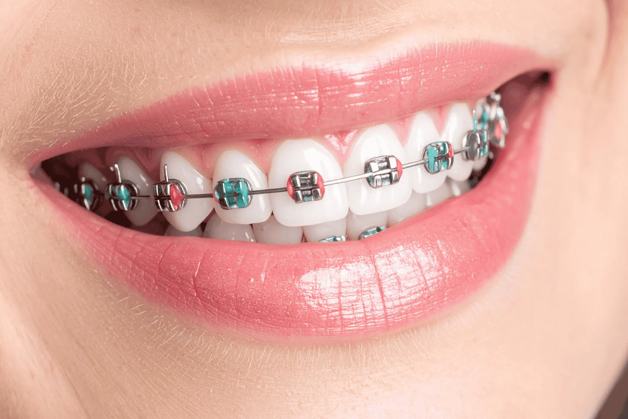 Metal and ceramic braces treatment at Caswell Orthodontics in Honolulu