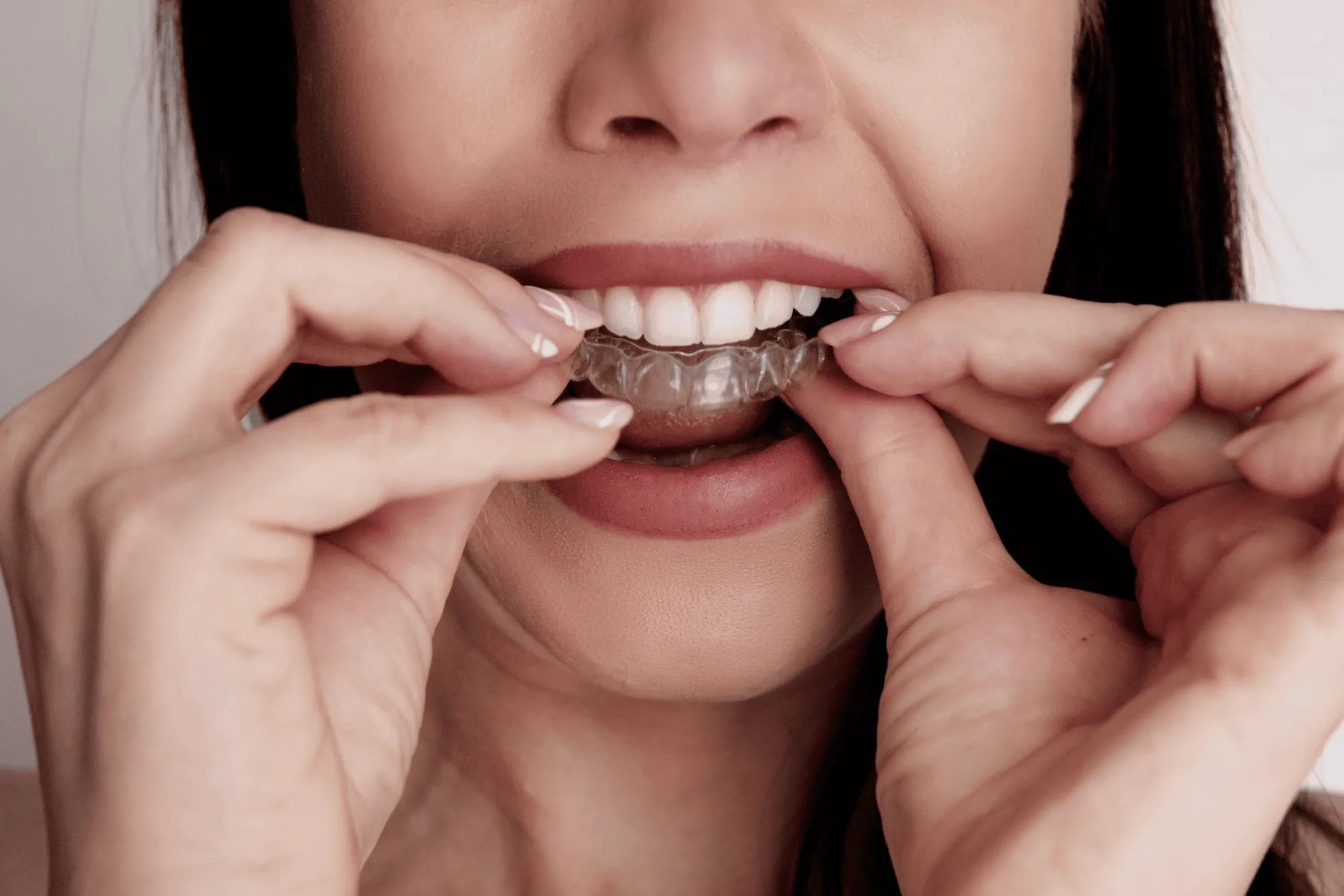 Clear aligners from Caswell Orthodontics in Honolulu